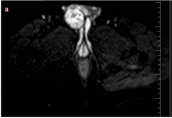 Solitary fibrous tumor/hemangiopericytoma of the penis