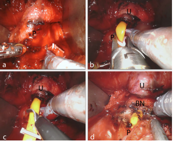 Gasless robotic perineal radical prostatectomy: An initial experience