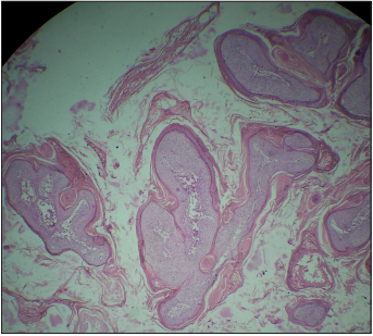 Squamous papilloma of the renal pelvis mimicking transitional cell carcinoma