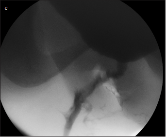 A new technique of double-face buccal graft urethroplasty for female urethral strictures